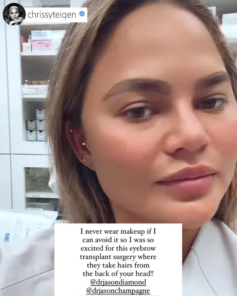 Chrissy Teigen revela que se sometió a una cirugía de trasplante de cejas